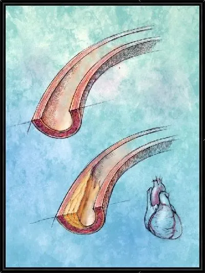 Картина Артерии (Arteries)