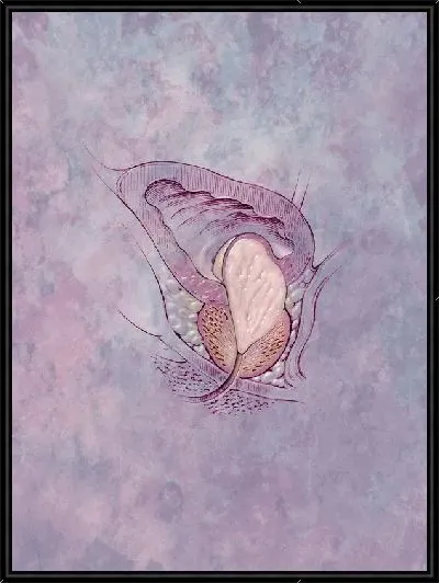 Картина Предстательная железа (Prostate)