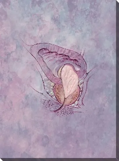 Постер Предстательная железа (Prostate)