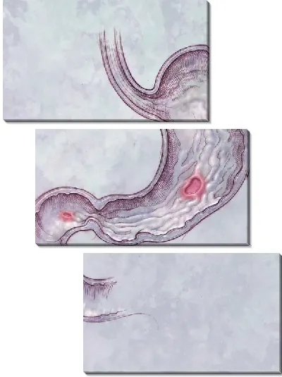 Модульная картина Желудок (Stomach) №2