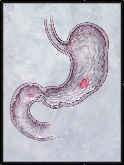 Картина Желудок (Stomach) №2
