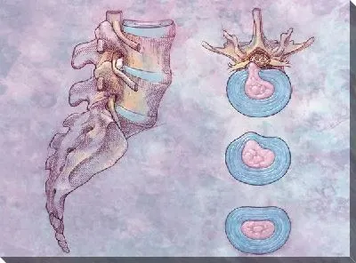 Межпозвонковые диски (Intervertebral discs)